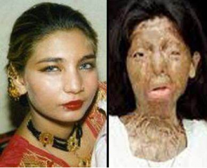Pakistani Acid Victim Loses Hope and Commits Suicide